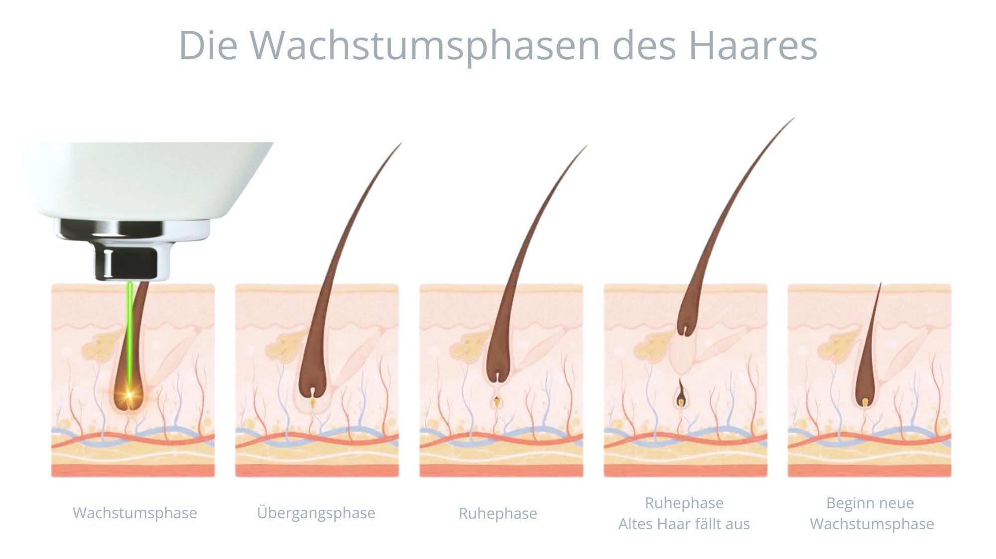 Die Wachstumsphasen des Haares – Infografik zeigt warum mehrere Laser-Sitzungen für optimale Ergebnisse notwendig sind