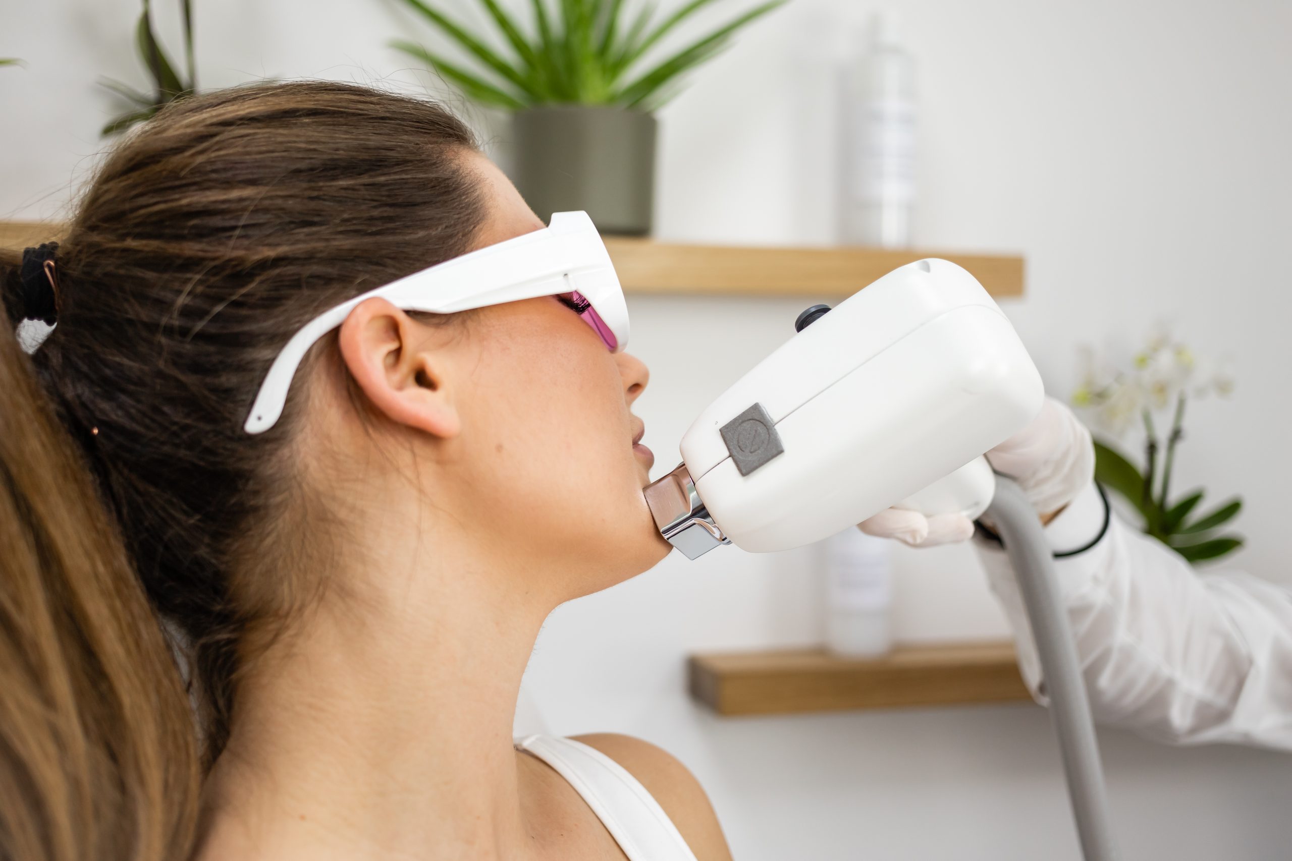 Präzise Diodenlaser-Behandlung am Kinn bei Bellalashes – professionell, sanft und individuell abgestimmt